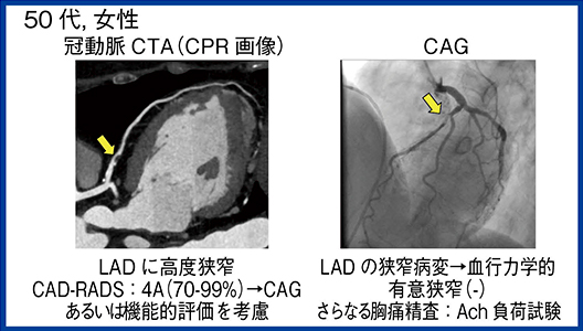 図3　シナリオ3　50代，女性，急性冠動脈症候群疑い