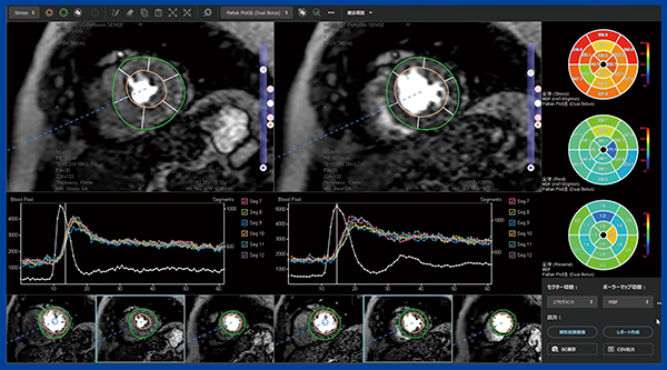 図3　‌REVORASによる心筋パフュージョンMRIの定量解析結果