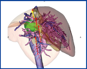 図5　症例2：肝離断へのアプローチ