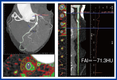 図2　Ziostation REVORASのFat Attenuation Index（FAI）