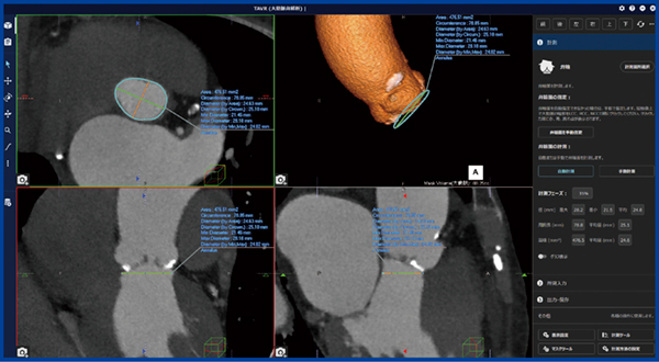 図2　REVORAS「TAVR大動脈弁解析」の弁輪面計測～弁輪面の自動認識 左画面は4分割で各viewを表示，右コラムに計測や操作ボタン，解析結果の数値が表示される。
