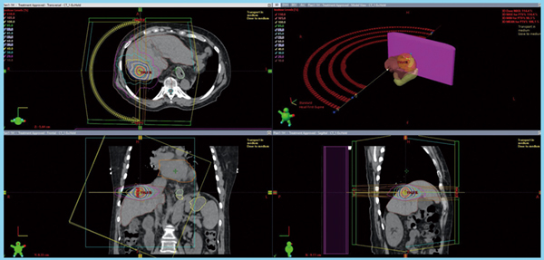 図2　HCCに対するSBRTの治療計画の一例