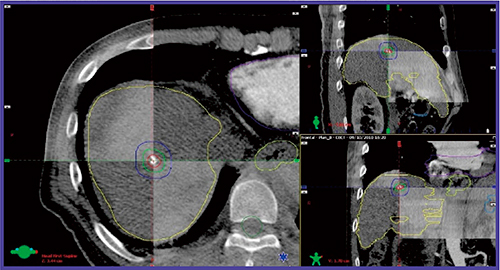 図1　肝臓癌SBRTにおけるCBCTによるIGRTの例