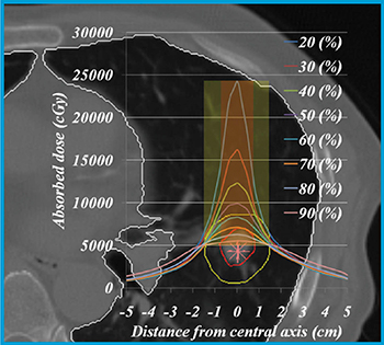 図1　PTV辺縁と20〜90％ isodose曲線がフィットするように作成された線量プロファイル 20％ isodose曲線とPTVを一致させた場合には，最大線量は250Gyとなり，照射野がとても小さくなる。一方，モニターユニット値はとても大きくなる。