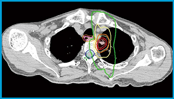 図4　左上葉肺腺癌2 病巣は一部壁側胸膜に浸潤を認め，食道にも近接している。線量分布上，脊髄，食道の線量を抑えられている。食道はたまに移動することがあるため，治療の際には注意が必要である。 食道（○），食道PRV（＋3mm）（○），脊髄（○），脊髄PRV（＋3mm）（○），GTV（○），PTV（○），等線量曲線は外側より16.7Gy（○），33.3Gy（○），50Gy（＝処方線量）（○），66.7Gy（○）