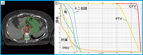 図3　肝細胞がんに対するSBRTの線量分布の一例 （胃，十二指腸，脊髄近接例：病巣はS1に存在する肝細胞がん） aの内側の○：GTV，○：PTV，等線量曲線は外側より11.4Gy（○），22.9Gy（○），34.3Gy（○），40Gy（○）（処方線量），51.4Gy（○）。リスク臓器である胃（○），十二指腸（○）にそれぞれ3mmを付与して計画リスク臓器体積（PRV）としている。DVH（b）では，右側よりGTV（ー），PTV（ー），十二指腸（ー），胃（ー），脊髄（ー），PRV（胃と十二指腸合算＋3mm）（ー），肝臓（ー）。