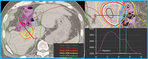 図4　肝細胞がんに対するSBRTの線量分布の一例（十二指腸，大腸近接例） 大船中央病院では，消化管近傍の肝細胞がんに対して42Gy/14回の分割照射を行っている。処方法としては，消化管PRVとPTVが重複する領域は42Gyに抑えつつ，重複しない領域に対しては70％ isodose曲線と一致させるようにしている。また，消化管PRVの最大線量は50Gyを超えないことにしている。左図の赤線の線量プロファイルを右図に示している。RapidArcを用いることにより，消化管PRVとPTV重複領域への線量を42Gyに抑えつつ，重複しない領域への線量が増加している。また，消化管では可及的に線量が抑えられている。このように，RapidArcは放射線治療医の要求に応じた線量分布を作成可能にしている。 大腸（○），十二指腸（○），PTV（○）。等線量曲線は外側より12Gy（○），24Gy（○），36Gy（○），42Gy（○）（処方線量），54Gy（○）。
