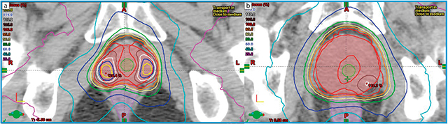 図3　前立腺に対するSIB-SBRTの線量分布 aは前立腺両葉のMRIで描出される病変に対してSIBを行った症例。リスク臓器の線量を抑えつつ，病変部位の平均線量は処方線量の114％，最大線量129％のSIBを行った。一方で，bのようにboostを行う領域が前立腺背側に寄っていると，尿道と直腸の線量を制約内に抑えるために，あまり線量は上がらない傾向がある。
