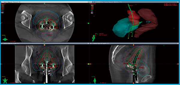 図3　コーンビームCTによるIGBT治療計画