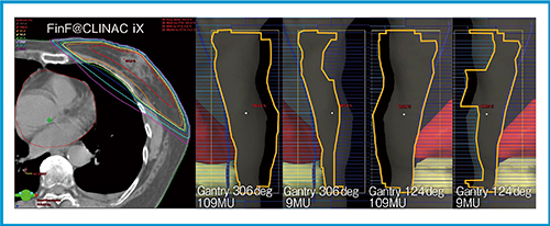 図1　「CLINAC iX」（バリアン社製）によるFinF法の線量分布と各ビームのBeam’s Eye View