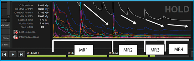 図2　Multi-Resolution Dose Calculationによる最適化コストの推移