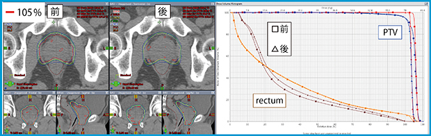 図3　Continue the previous optimizationの使用前後の前立腺VMATの線量分布とDVH