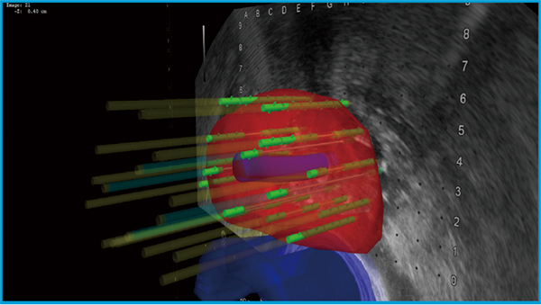 図2　線源挿入後の三次元的な線源配置 超音波画像のスライス位置も重ねて表示できる。
