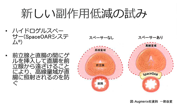 SpaceOARハイドロゲルで前立腺と直腸を物理的に遠ざけ，直腸への照射線量を低減する。