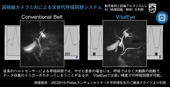 精度の高い呼吸同期が可能なVitalEye