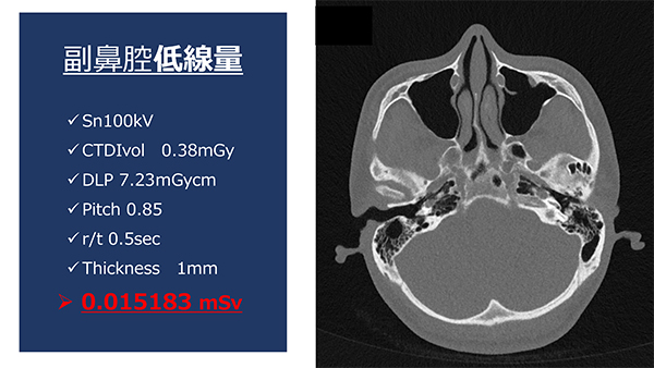 副鼻腔の超低線量撮影